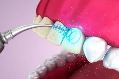 Ультразвуковая чистка зубов Air Flow